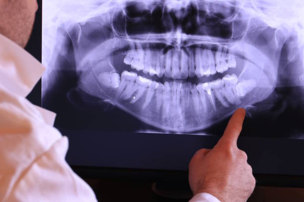Best Emergency Wisdom Tooth Extraction in Sapulpa, OK