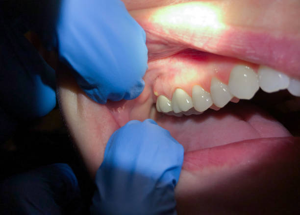 Best Lost Filling or Crown Replacement in Sapulpa, OK